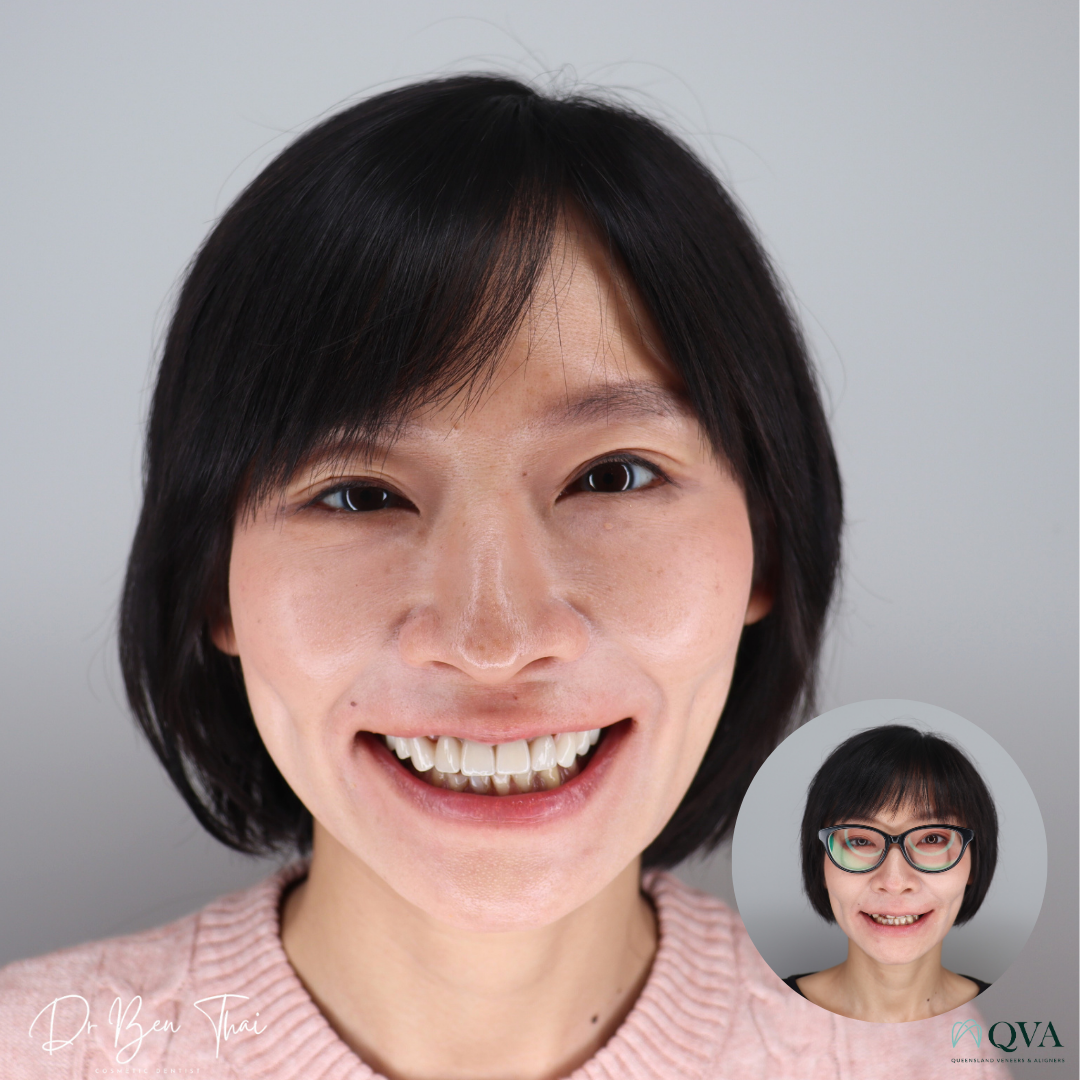Before and After smile photo of a patient who undertook QVA Clear Aligner Smile transformation