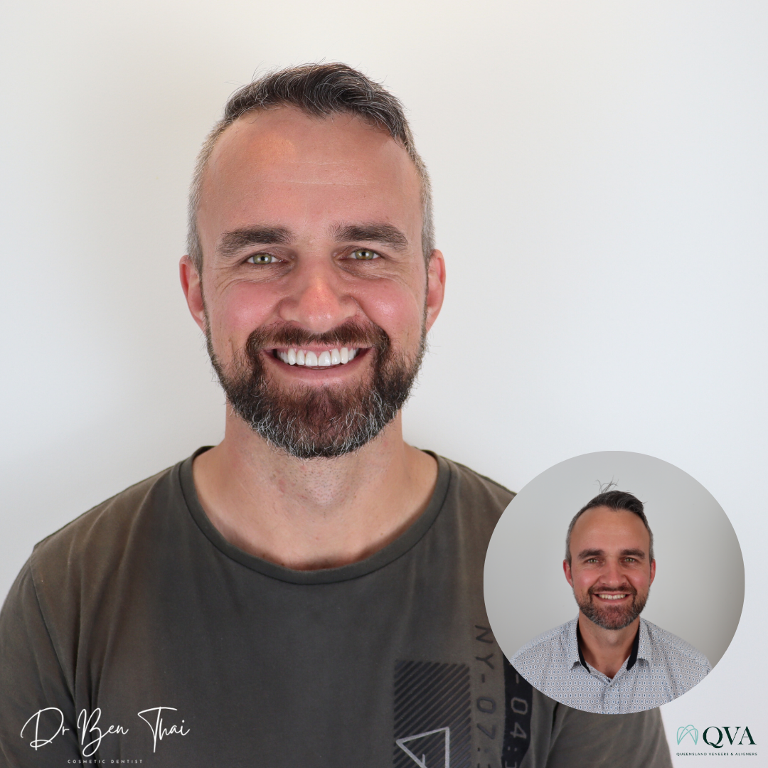 Before and After smile photo of a patient who undertook QVA Clear Aligner Smile transformation