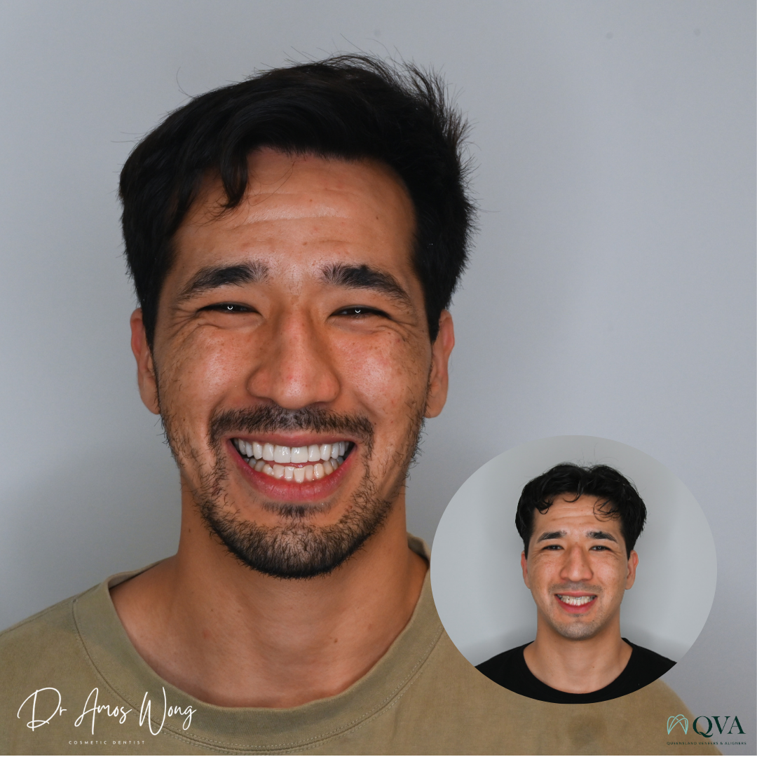Before and After smile photo of a patient who undertook QVA Aesthetic Rehab Smile transformation