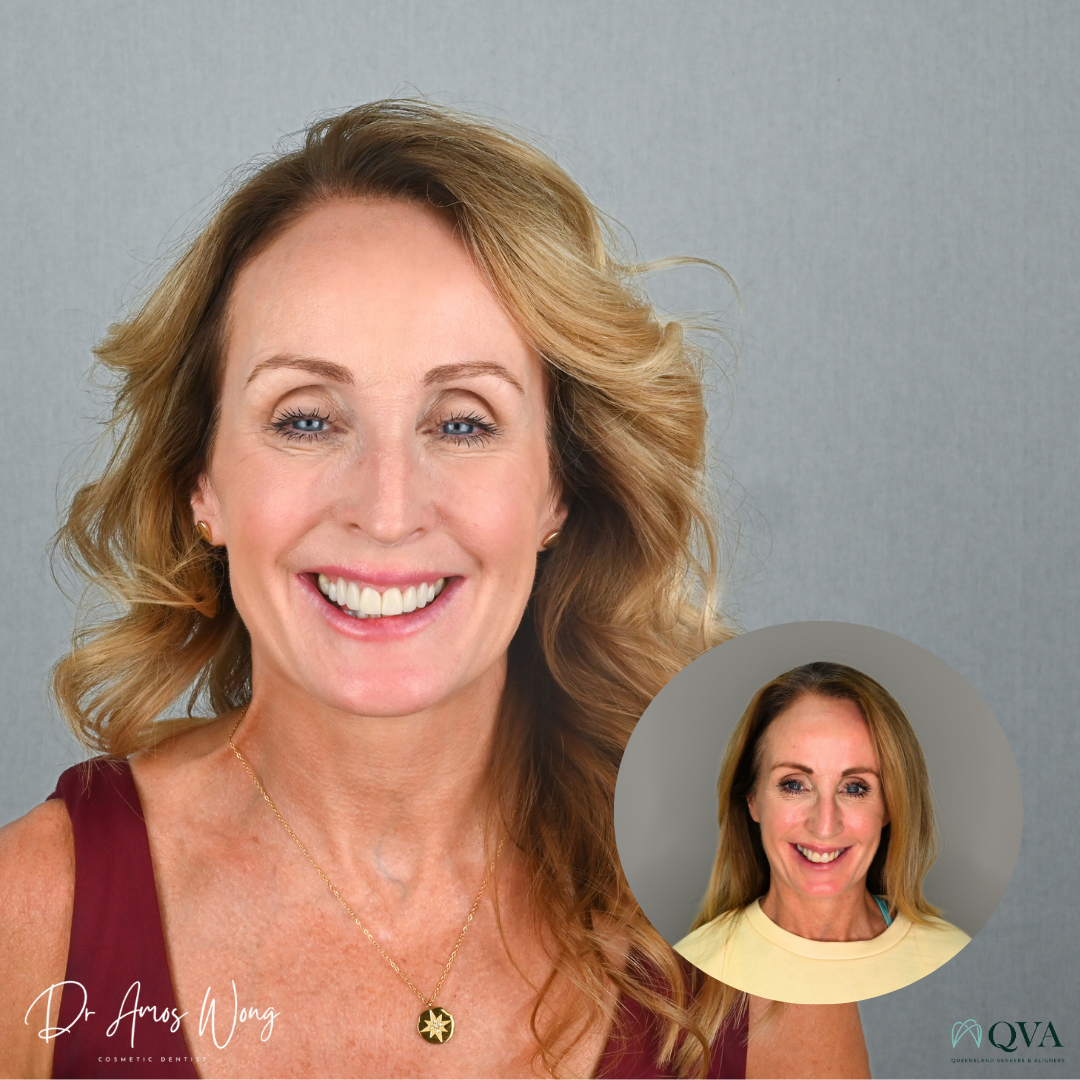 Before and After smile photo of a patient who undertook QVA Aesthetic Rehab Smile transformation
