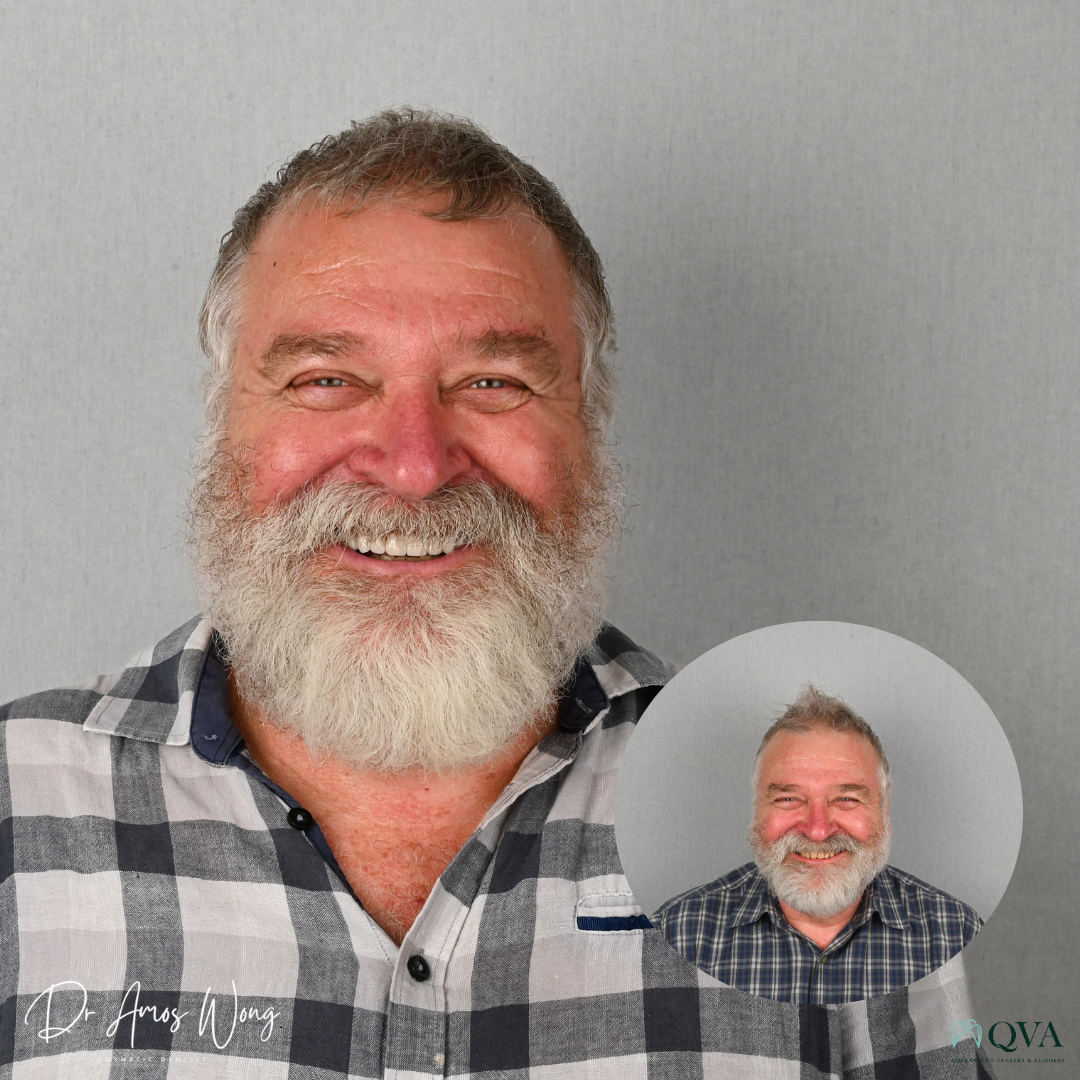 Before and After smile photo of a patient who undertook QVA Aesthetic Rehab Smile transformation