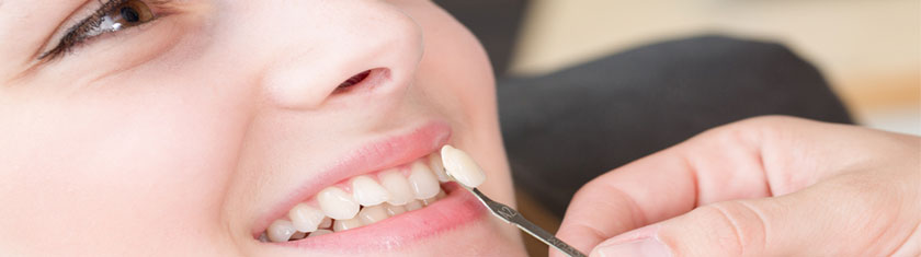 A porcelain veneer being held above a tooth to check colour