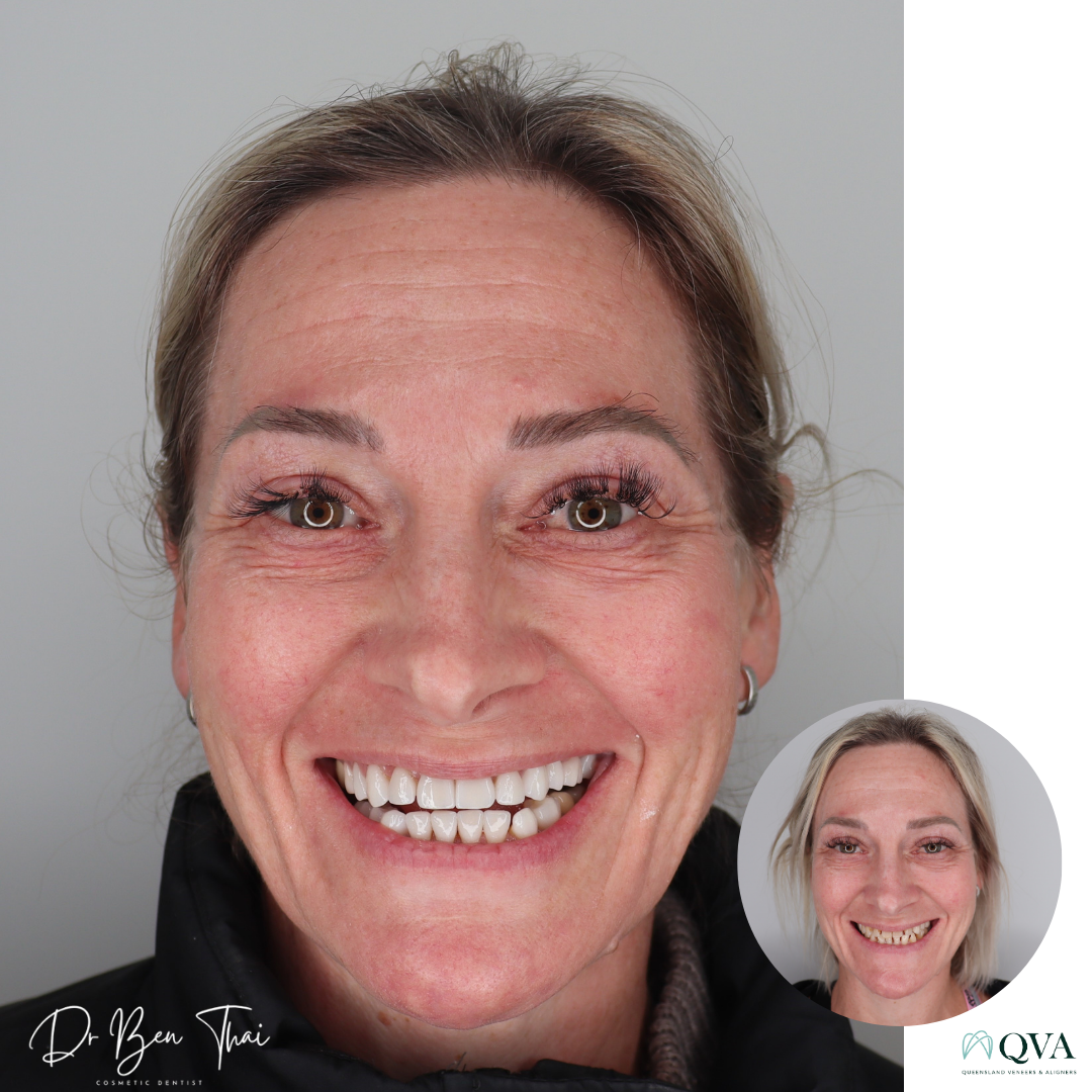 Before and After smile photo of a patient who undertook QVA Clear Aligner Smile transformation