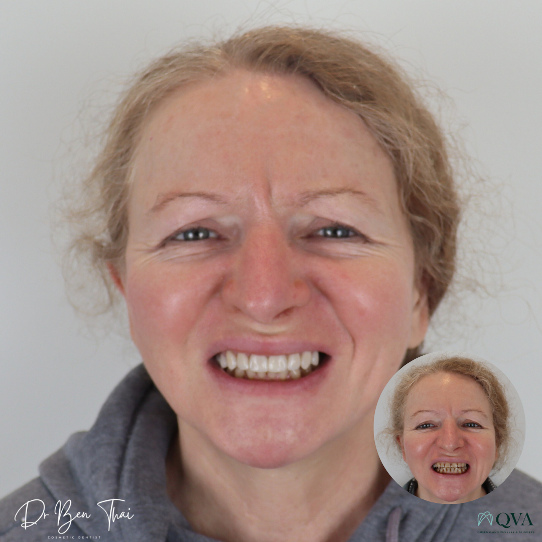 Before and After smile photo of a patient who undertook QVA Clear Aligner Smile transformation