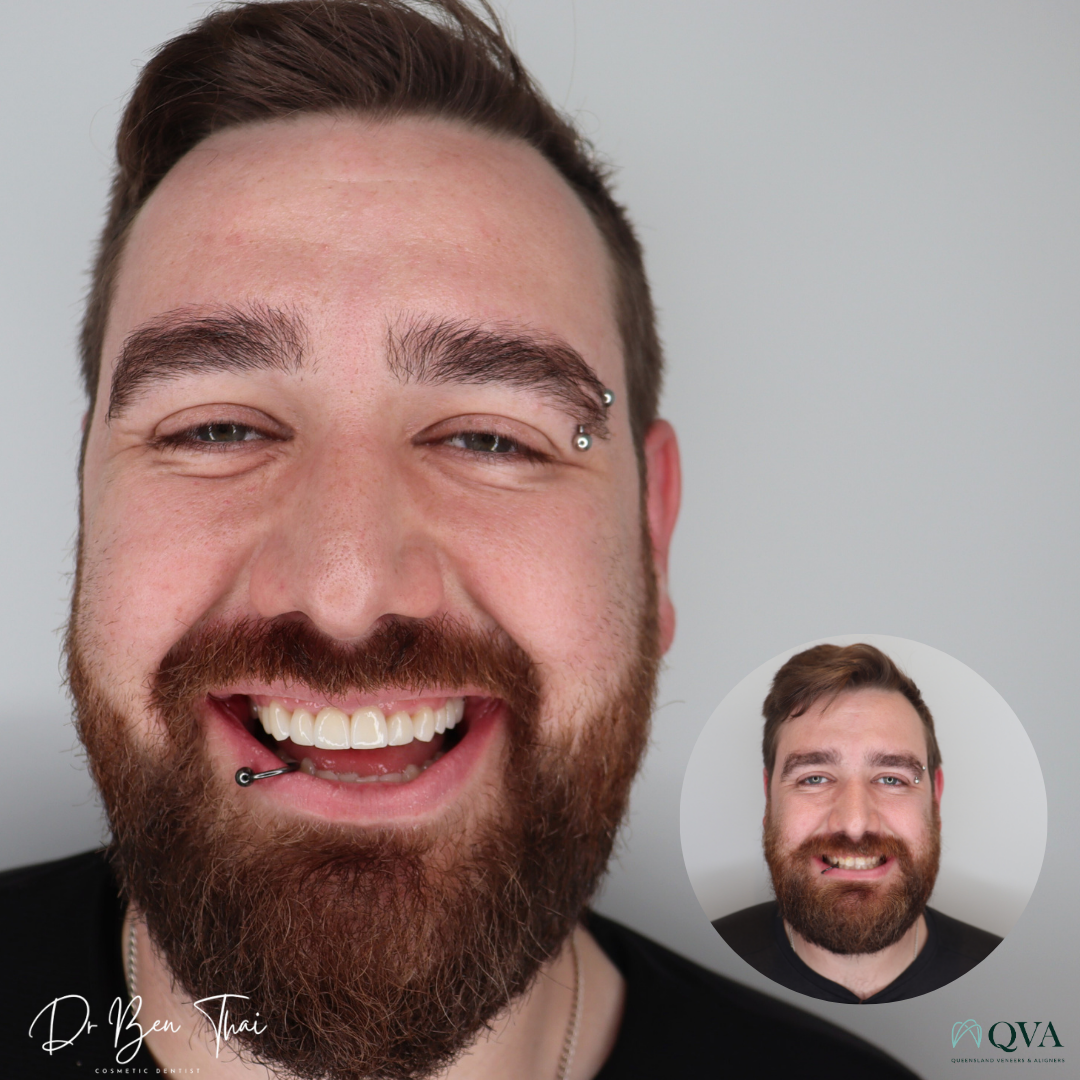 Before and After smile photo of a patient who undertook QVA Clear Aligner Smile transformation